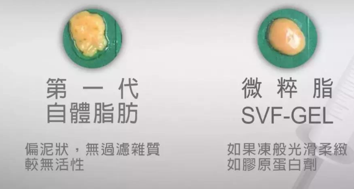 自体脂肪丰胸