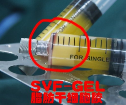 自体脂肪丰胸