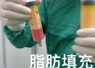 自体脂肪丰胸