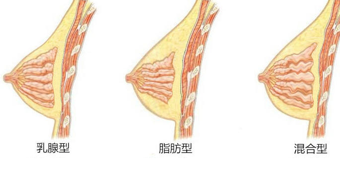 自体脂肪丰胸