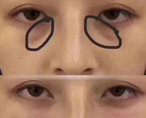 泪沟