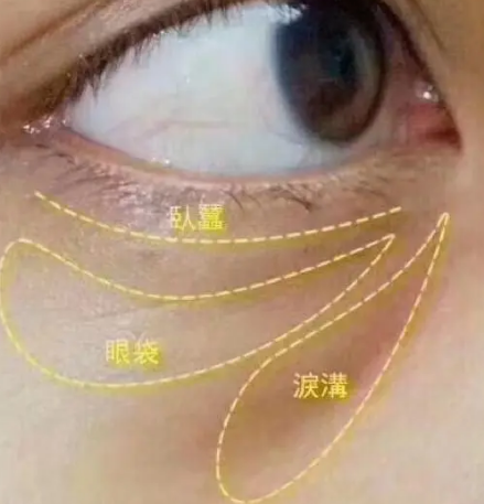 泪沟