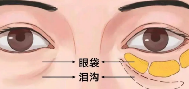 泪沟