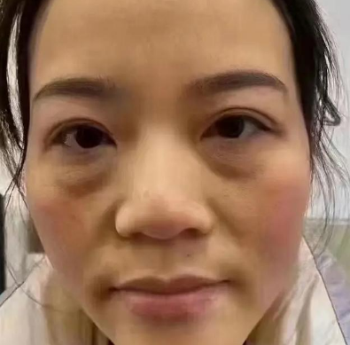 泪沟