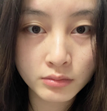 泪沟