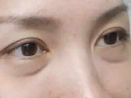 泪沟填充