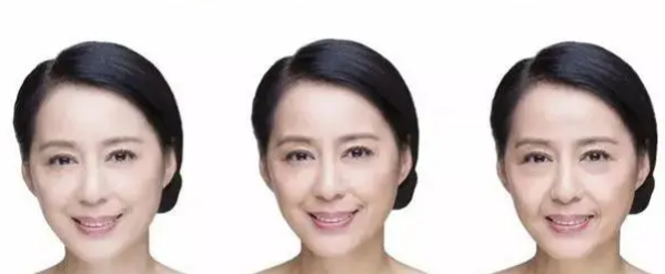 自体脂肪填充