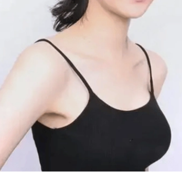 自体脂肪填充