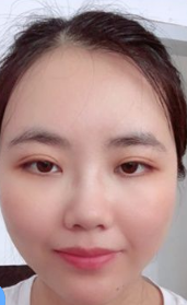 自体脂肪填充