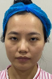 自体脂肪填充