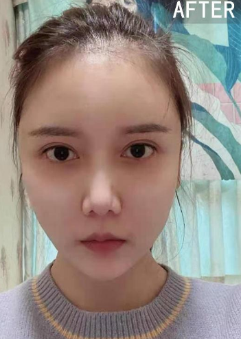 自体脂肪填充