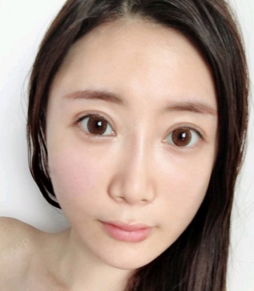 自体脂肪填充