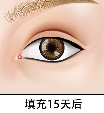 自体脂肪填充