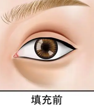 自体脂肪填充