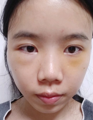 自体脂肪填充