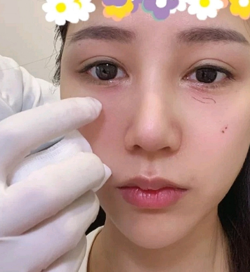自体脂肪填充