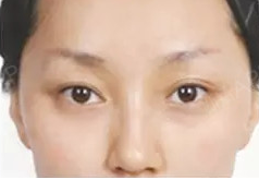 自体脂肪填充