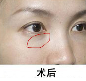 自体脂肪填充