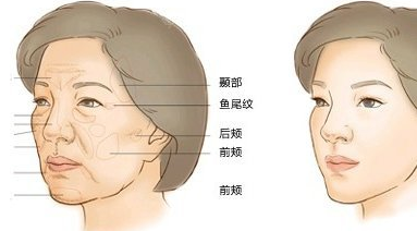 泪沟