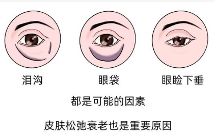 泪沟