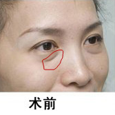 自体脂肪填充