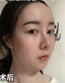 自体脂肪填充