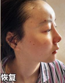 自体脂肪填充