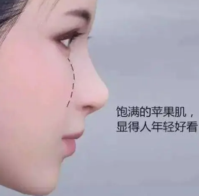 自体脂肪填充