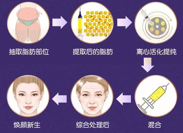 自体脂肪填充