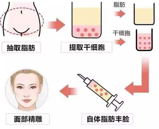 自体脂肪填充