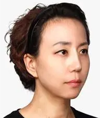 自体脂肪填充
