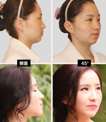 自体脂肪填充
