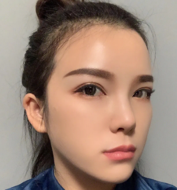 自体脂肪填充