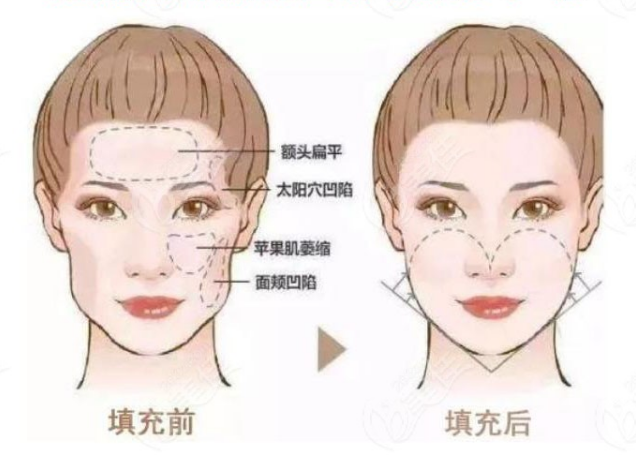 自体脂肪填充
