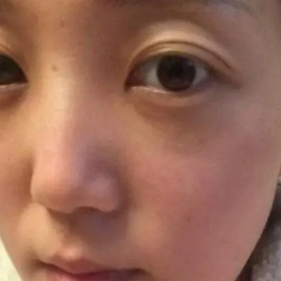 去眼袋手术