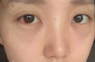 去眼袋手术