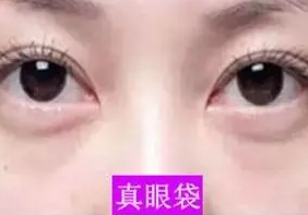 眼袋