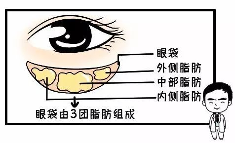 眼袋手术