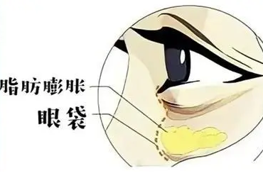 眼袋