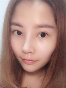 自体脂肪填充