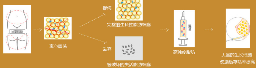 自体脂肪丰胸