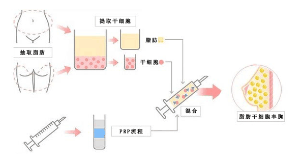 自体脂肪丰胸