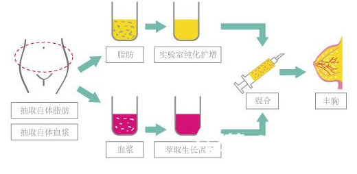自体脂肪丰胸