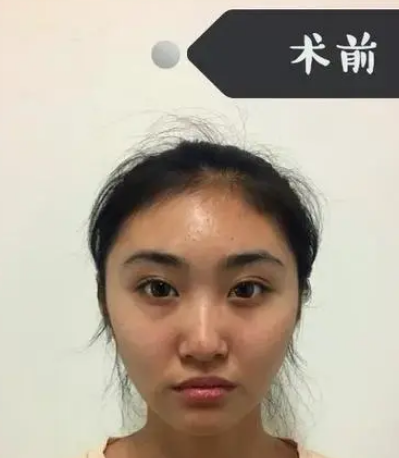 眼袋