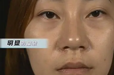 眼袋