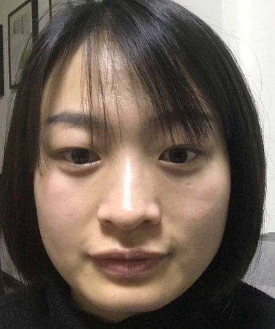 眼袋手术