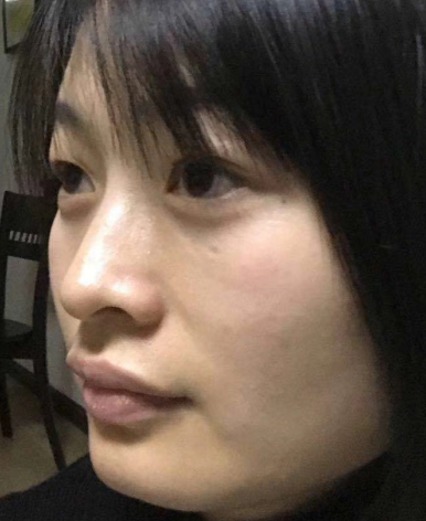 眼袋手术