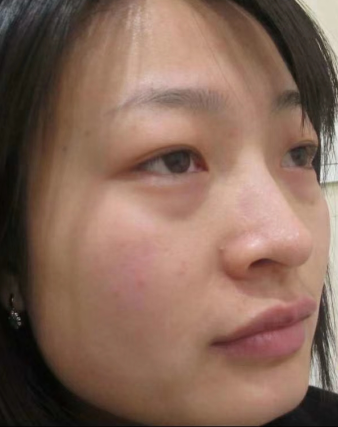 眼袋手术