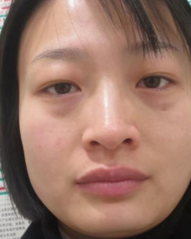 眼袋手术