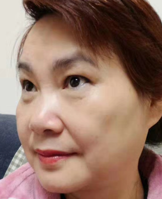 眼袋手术